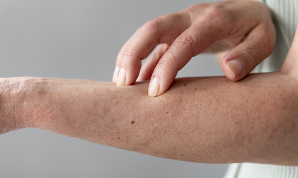 Where do bed bugs bite - Are bed bug bites itchy